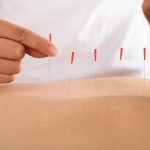 working of dry needling