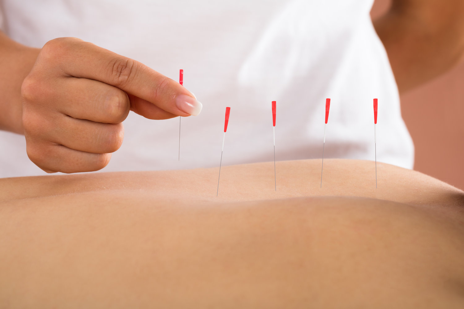 working of dry needling